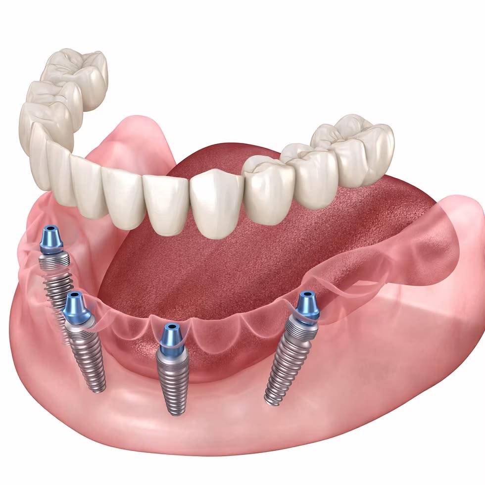 Lucrare finală zirconiu